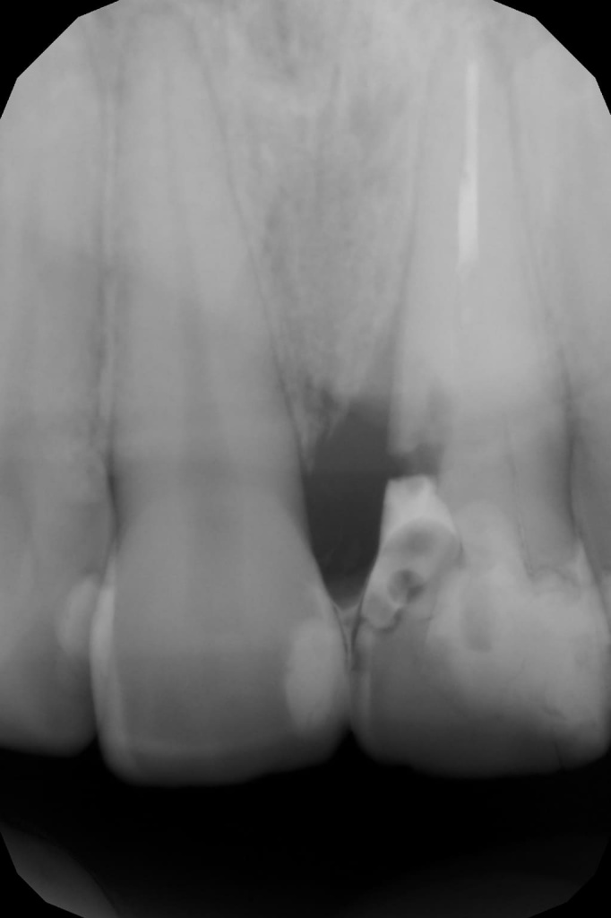 рентгеновский снимок зуба
