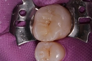 До/После: Эстетическая реставрация жевательного зуба