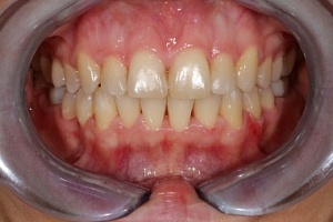 До/После Ортодонтическое лечение
