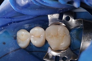 Восстановление зуба керамической вкладкой: До/после