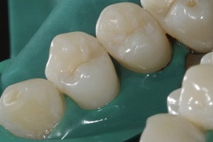 Фото работы по лечению кариеса и восстановление анатомической формы зубов