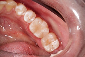 Лечение кариеса и реставрация зуба композитным материалом: До/После