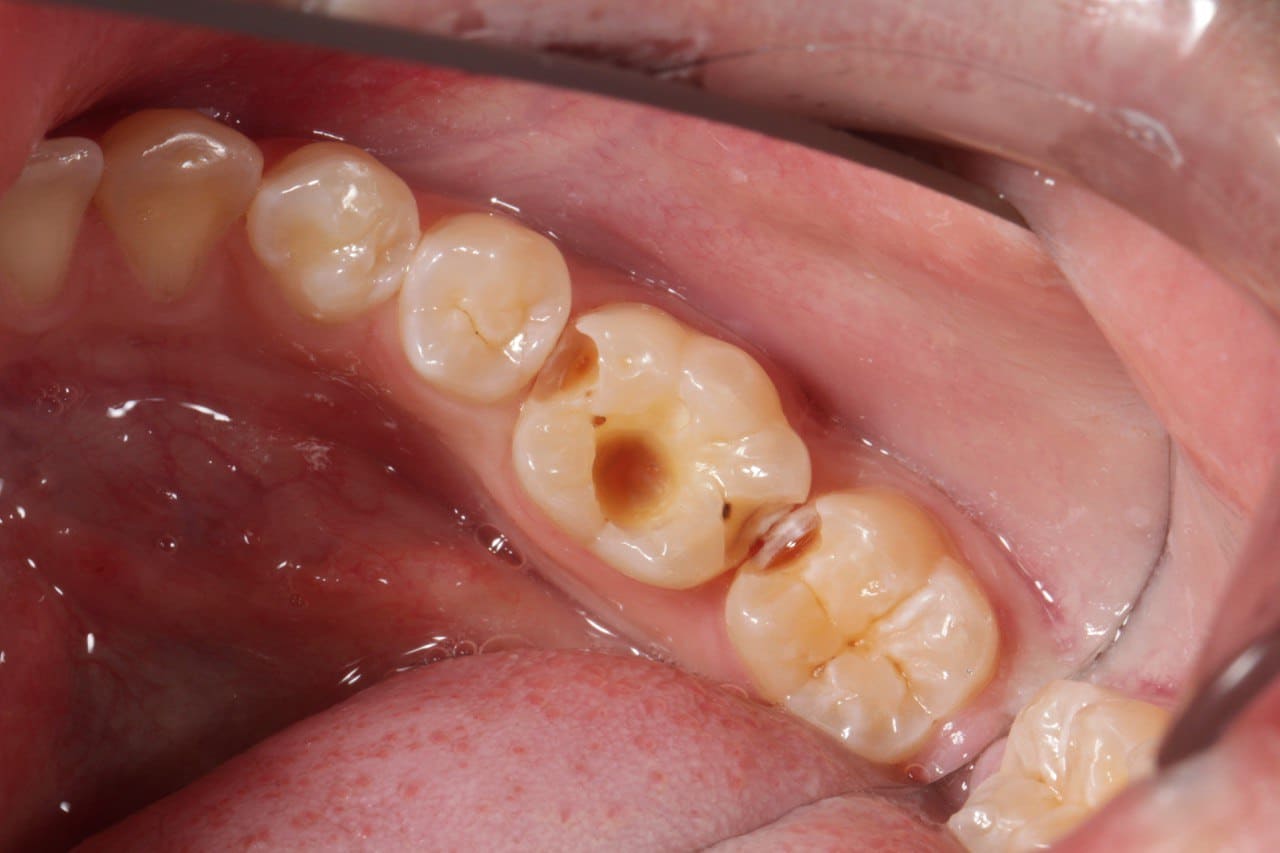 Фото работы до лечения кариеса и реставрации зуба композитным материалом