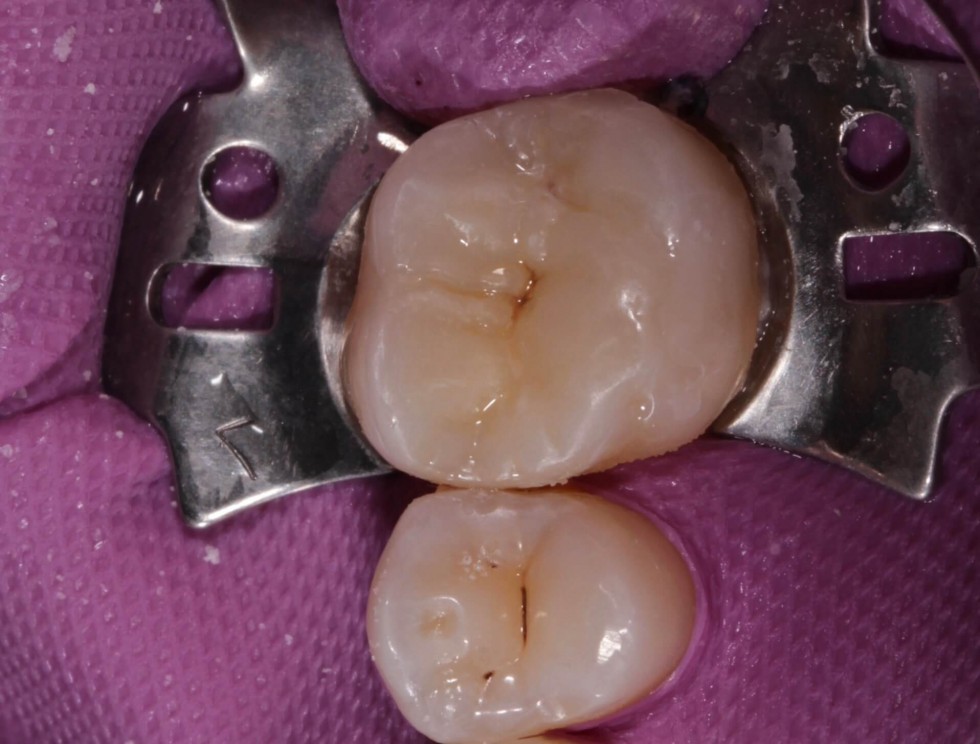 Эстетическая реставрация жевательного зуба: после