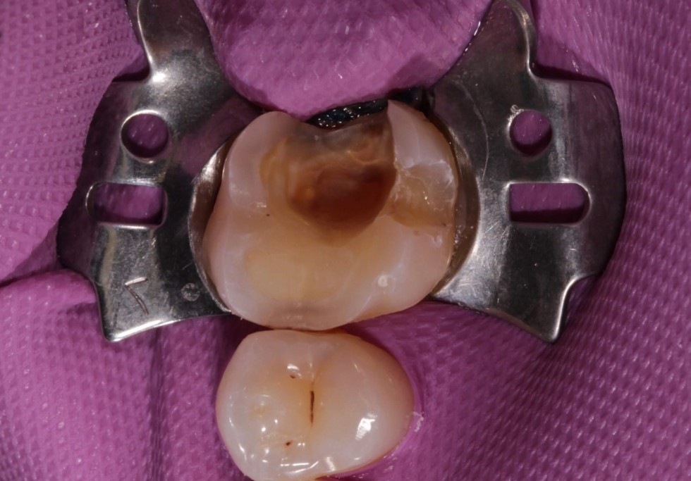 Эстетическая реставрация жевательного зуба: до