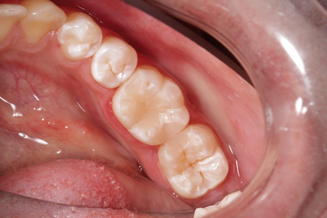 Фото работы после лечения кариеса и реставрации зуба композитным материалом