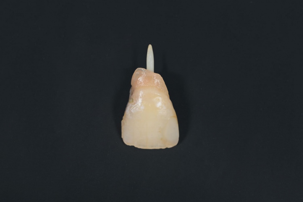 отломок коронки зуба