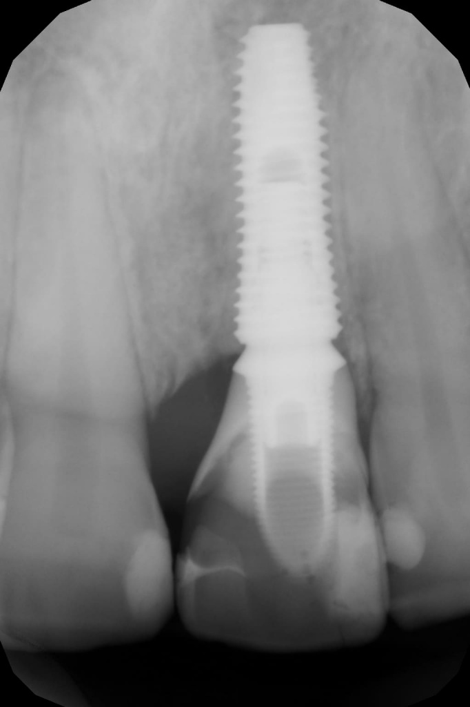 рентгеновский снимок имплантата с временной коронкой