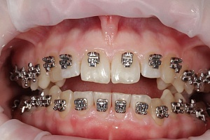 Пример работы чистки на этапе ортодонтического лечения